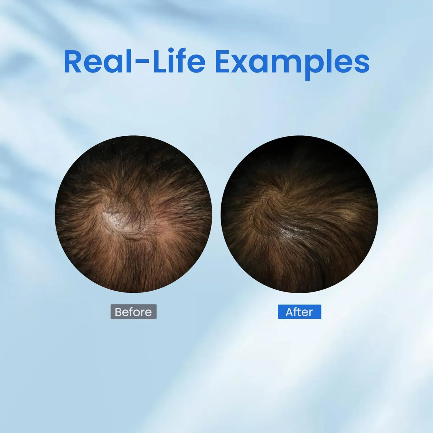 0.5% KX-826 DHT Blocker Hair Thickening Growth Products,3 Days Oil Control 1-2 Weeks Hair Loss Reduction 4-6 Weeks New Hair Visible,Hair Growth Spray Regrowth Treatments Men&Women (blue)