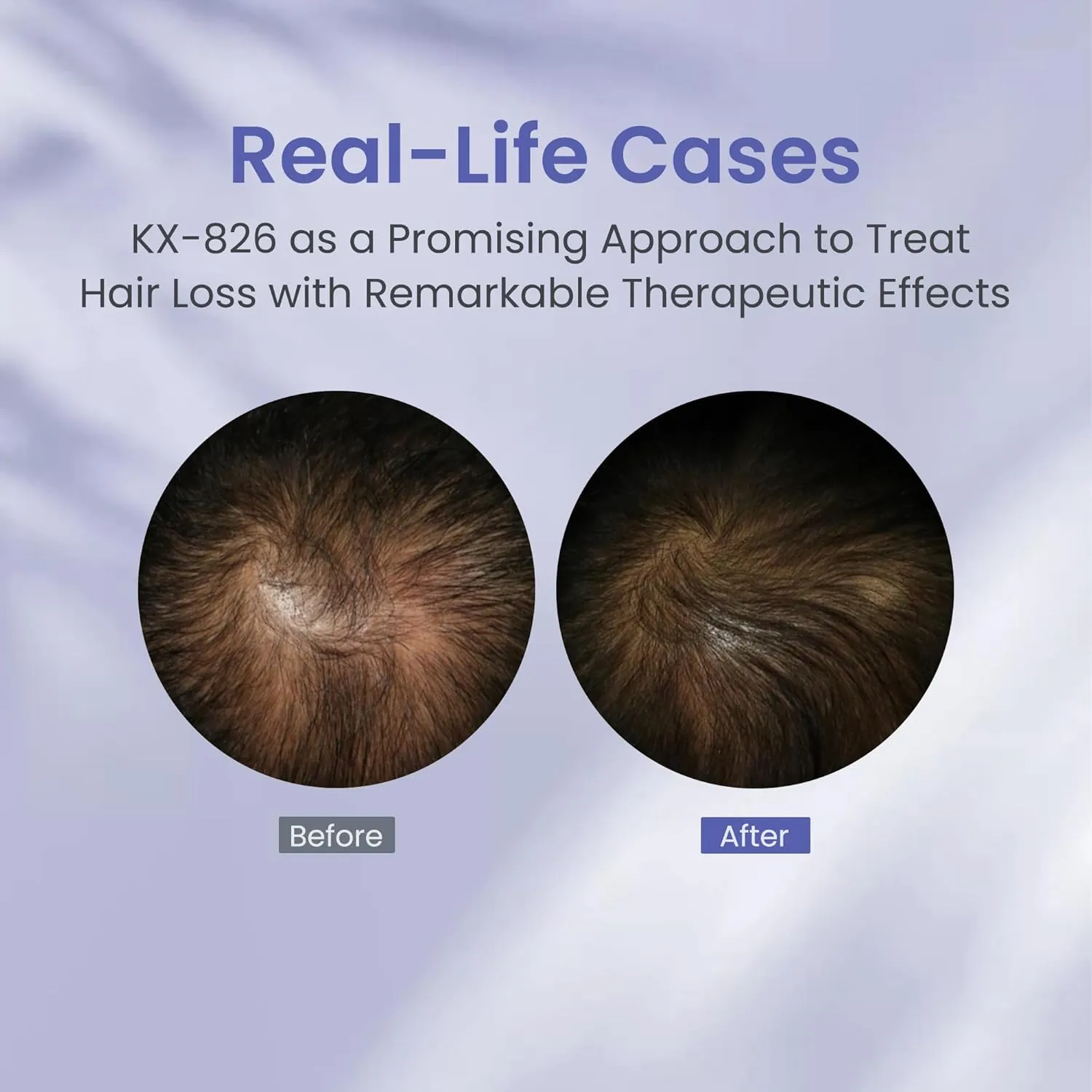 0.9% DHT Blocker KX-826 Hair Growth Products,3 Days Oil Control 1-2 Weeks Hair Loss Reduction 4-6 Weeks New Hair Visible,Hair Growth Spray Regrowth Treatments Men&Women -2 Month Supply 60ml Pro